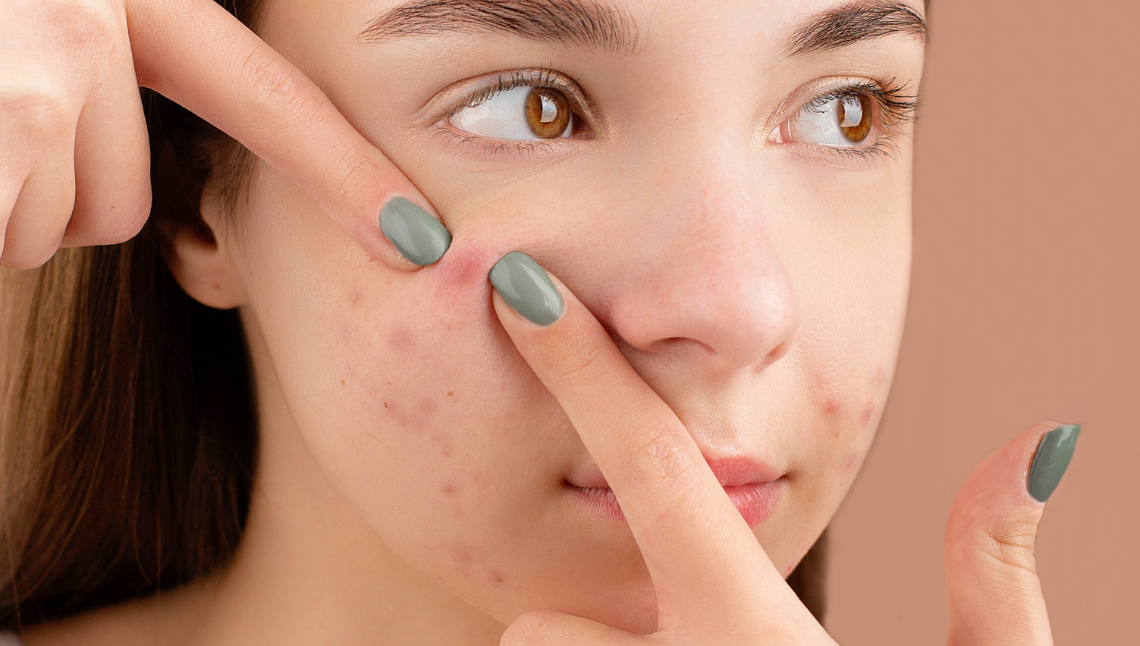 Come trattare la pelle acneica