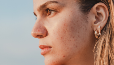 Come prevenire le cicatrici da acne?