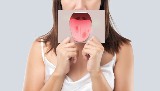 Stomatite sulla lingua: cause e come curarla
